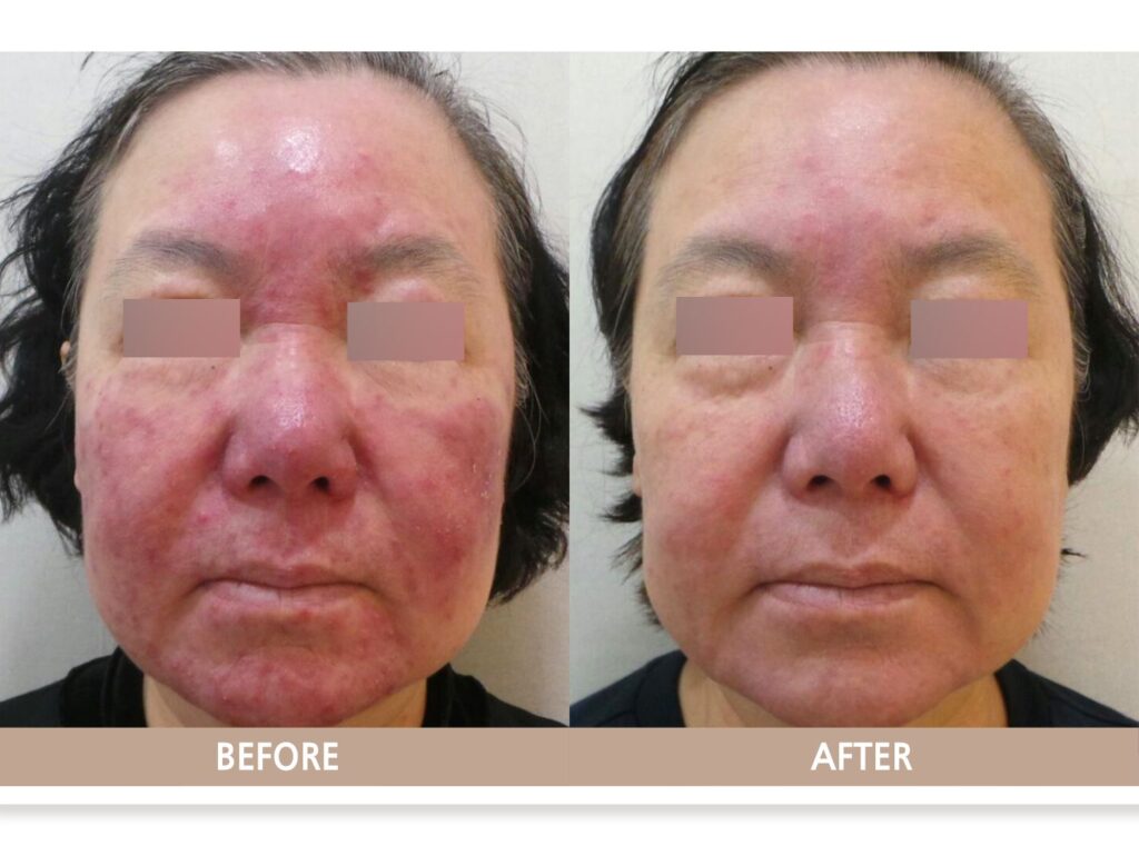 얼굴 홍조 원인에 따른 치료 전후를 정면에서 비교한 사진으로, 치료 후 붉은기와 염증성 구진이 완화된 모습을 보여줍니다.