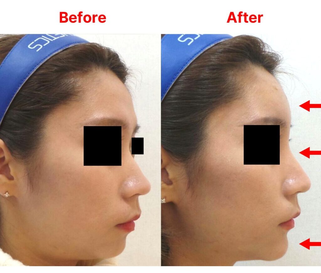 리뉴앤영 일산 이마, 코, 턱 필러 전후사진. 이마, 코, 턱 필러 시행 시 얼굴 전체의 비율이 중요합니다.