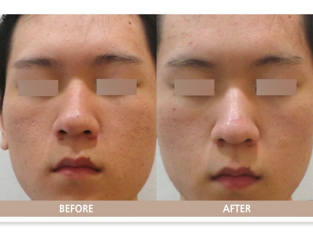 일산 여드름 흉터 및 모공 치료 전후사진 정면 비교