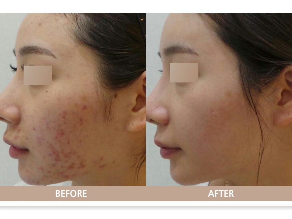 일산 여드름 치료 전후 피부 개선 사례