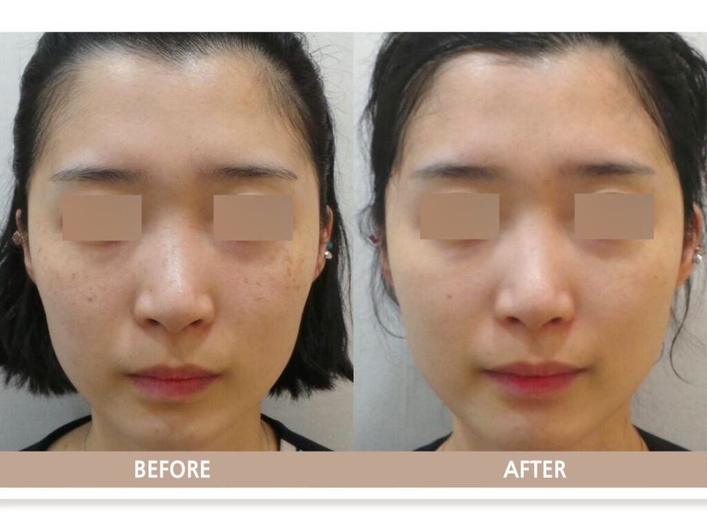 일산 리뉴앤영 의원에서 주근깨 치료 전후 피부 변화