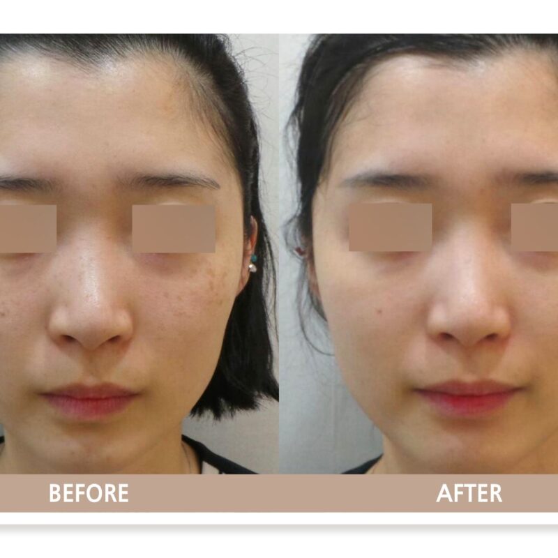 일산 리뉴앤영 의원에서 주근깨 치료 전후 피부 변화