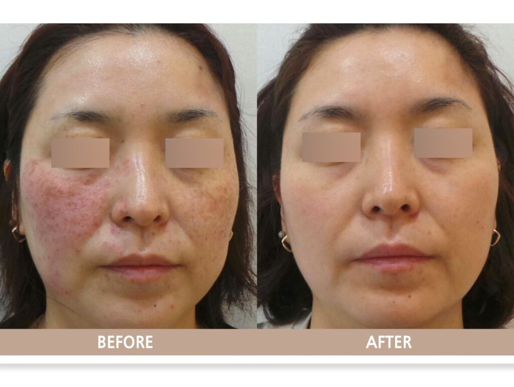 일산 흑자증 치료 전후사진 정면 비교