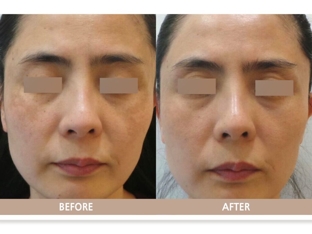 일산 리뉴앤영 의원에서 기미 치료 전후 피부 변화