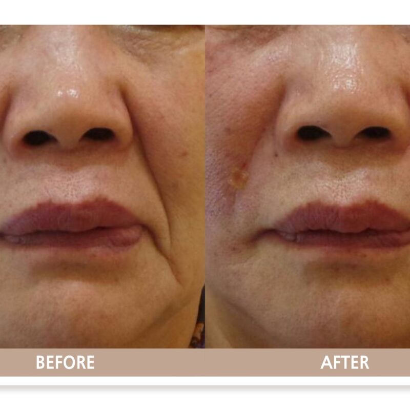 일산 리뉴앤영 의원에서 팔자 주름 필러 및 실리프팅 시술 전후 얼굴 변화