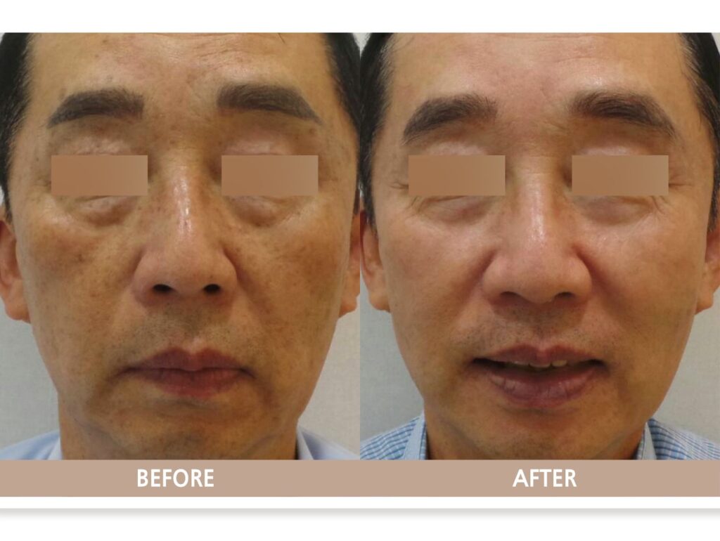 일산 리뉴앤영 의원에서 검버섯(흑자, 지루각화증) 레이저 치료 전후 피부 변화