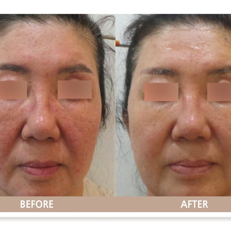 고양시 일산 리뉴앤영 의원 주사 피부염 및 홍조 레이저 치료 전후사진(정면)