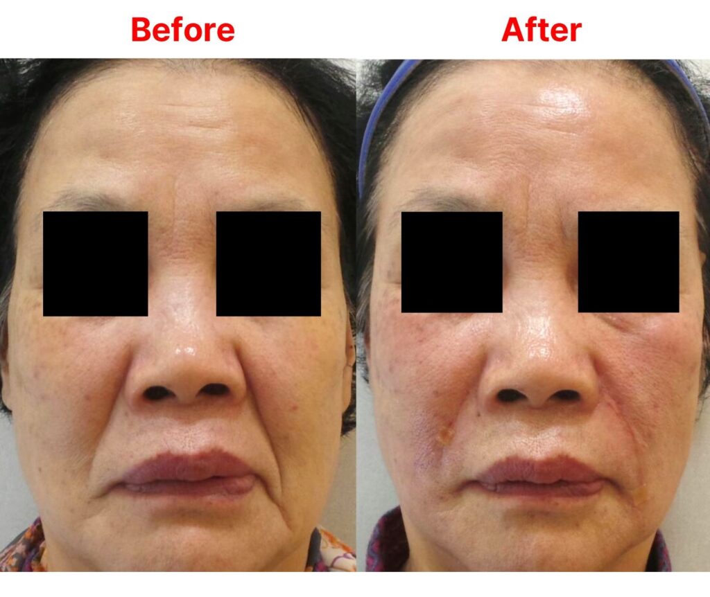 일산 리뉴앤영 의원에서 팔자 주름 필러 및 실리프팅 시술 전후 얼굴 변화. 오른쪽은 팔자 필러만 시행, 왼쪽은 팔자 실리프팅과 필러를 함께 시행.