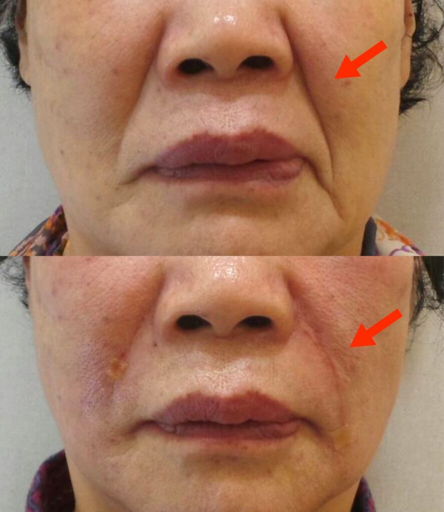주름이 깊은지, 얕은지에 따라 필러와 실리프팅을 병행하여 사용함. 얕은 주름은 팔자 필러 단독 시행으로 개선시킬 수 있지만, 깊은 주름의 경우 실리프팅이 필요함.