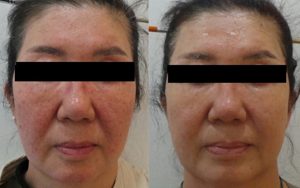 일산 리뉴앤영의 반복 재발하는 홍조 및 주사피부염의 레이저 치료 결과 사진.