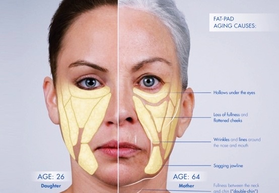 노화에 따른 얼굴 지방층의 변화. 나이가 들 수록 주름이 심해진다.