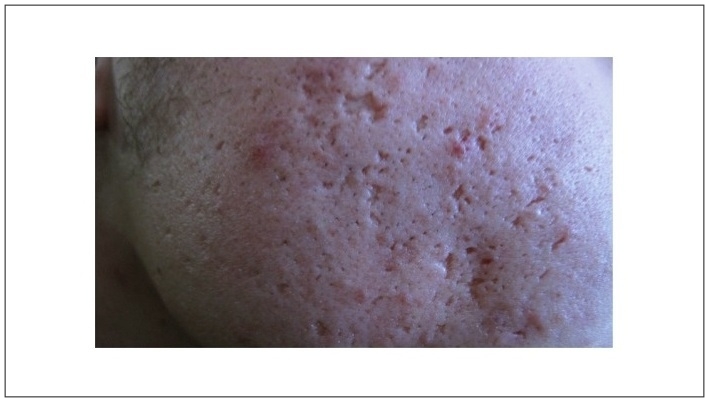 사춘기 여드름 흉터 생성 후 개선되지 않는 모습.