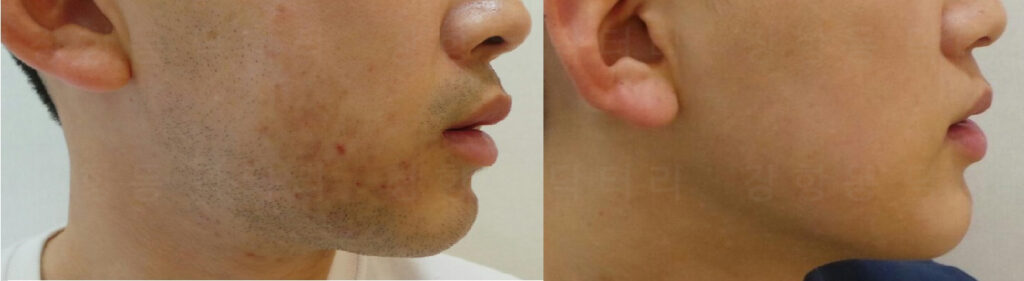 모낭염으로 인한 염증 후 색소침착