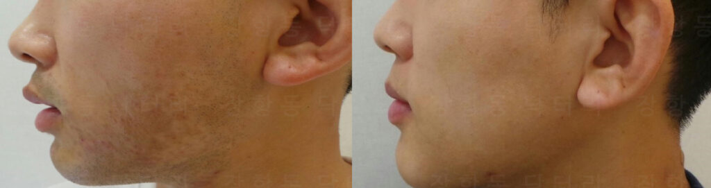 PIH 색소침착 병변의 일산 리뉴앤영 레이저 치료 전후 사진