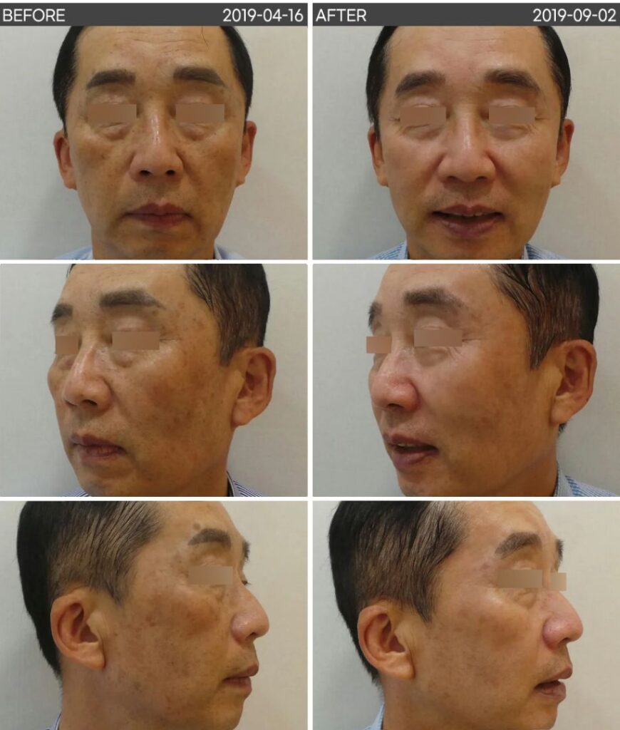 일산 검버섯 흑자 지루각화증 전후 사진