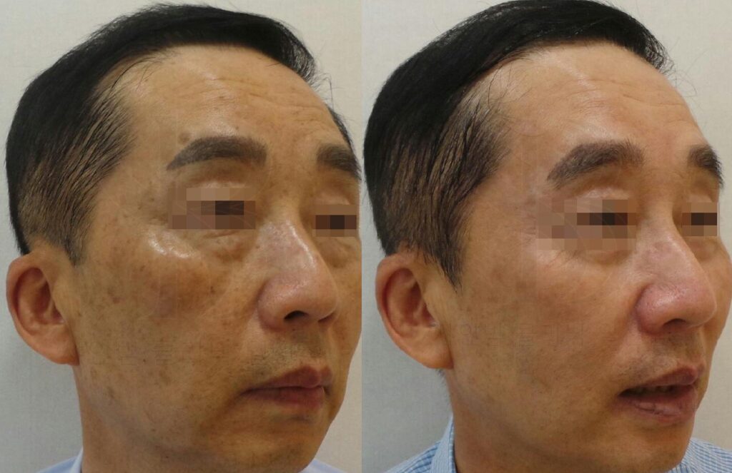 피코슈어 흑자 지루각화증 복합 사례 치료 전후