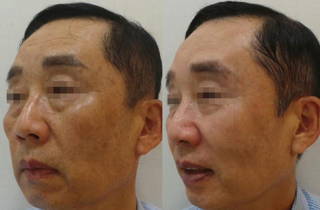 검버섯 흑자 지루각화증 피코슈어 치료 전후