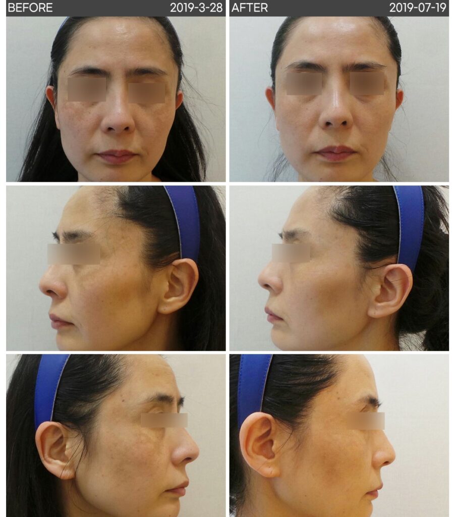 기미 레이저 치료 전후 사진