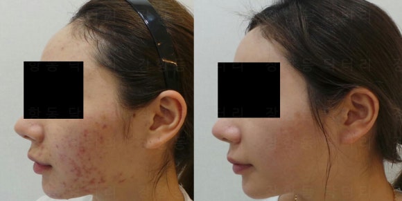 일산 리뉴앤영 여드름 치료 레이저 전후 사진 비교.