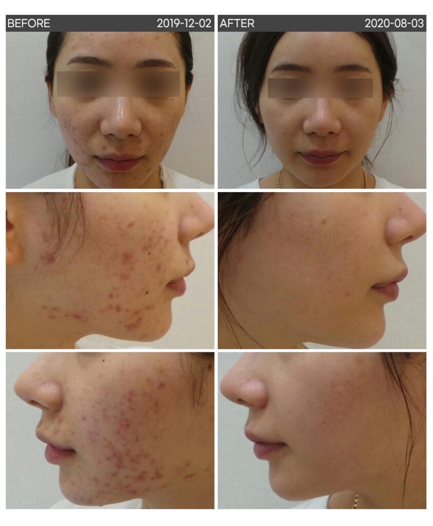 일산 리뉴앤영 의원에서 여드름 치료 전후 피부 변화