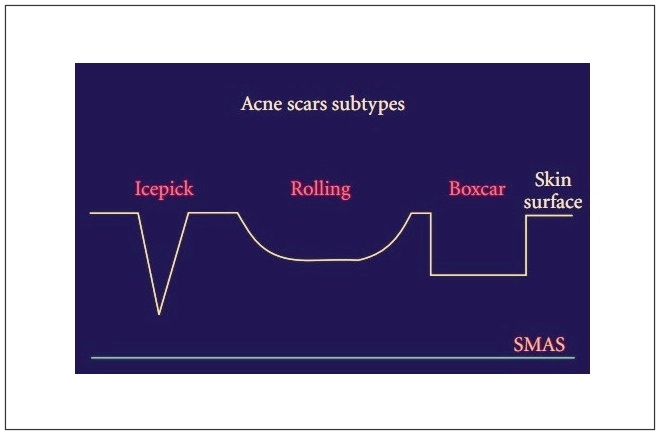 다양한 모양의 여드름 흉터
