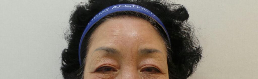 필러 시술 후 시간이 경과하여 자연스러워진 이마의 모습