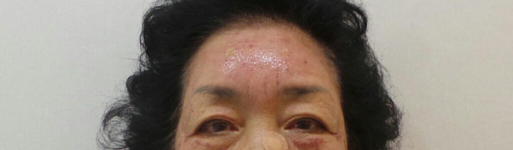 이마 주름 필러 및 이마 필러 시술 직후의 모습