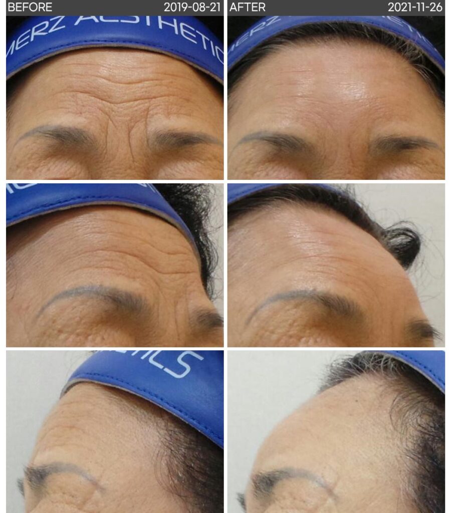 일산 리뉴앤영 의원에서 이마 주름 필러 및 이마 필러 시술 전후 얼굴 변화