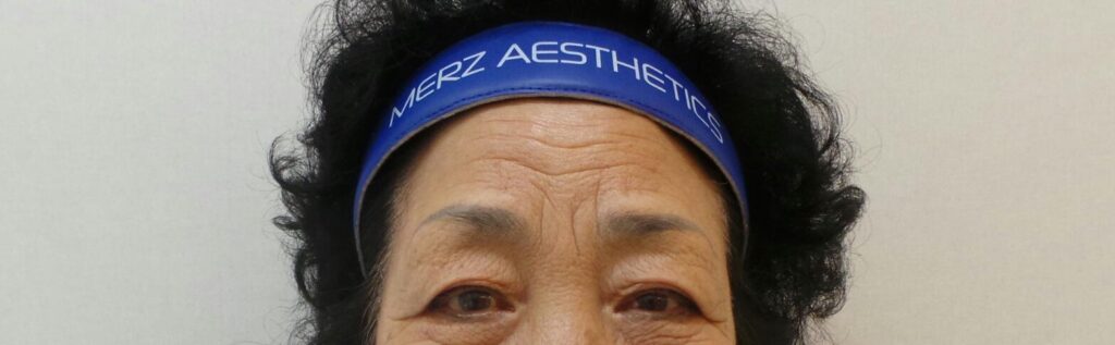 필러 시술 전 주름이 깊게 패인 이마의 모습