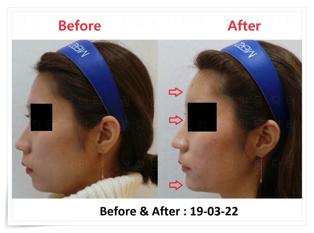 일산 리뉴앤영 의원에서 이마 필러 시행 시 코 필러와 턱 필러를 병행한 전후 얼굴 변화