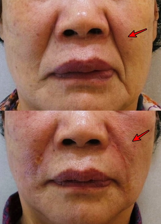 주름이 깊은지, 얕은지에 따라 필러와 실리프팅을 병행하여 사용함. 얕은 주름은 팔자 필러 단독 시행으로 개선시킬 수 있지만, 깊은 주름의 경우 실리프팅이 필요함.