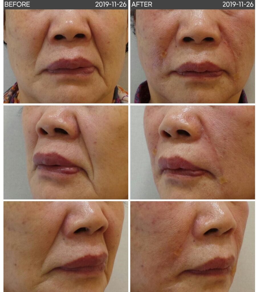 일산 리뉴앤영의 팔자 주름 필러 및 실리프팅 전후 사진. 옅은 팔자 주름은 팔자 필러로, 깊은 주름은 필러와 실리프팅을 병행하여 개선.