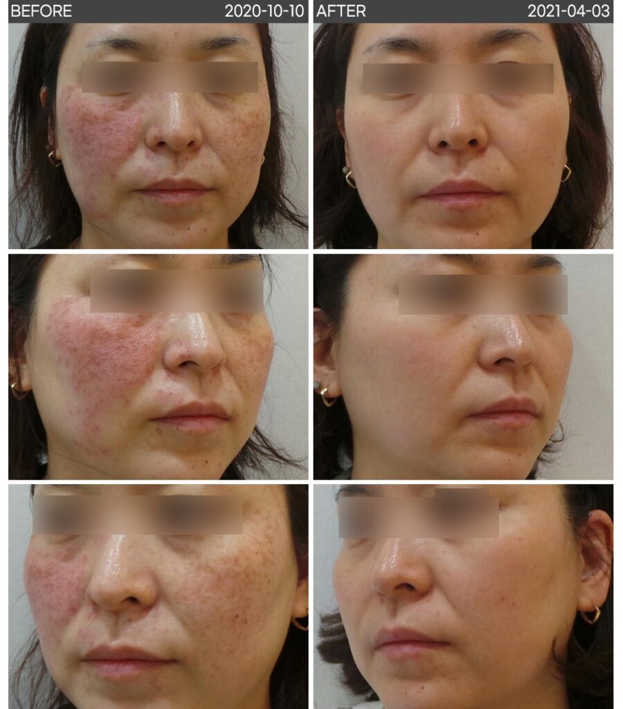 일산 리뉴앤영 의원에서 흑자증 레이저 치료 전후 피부 변화