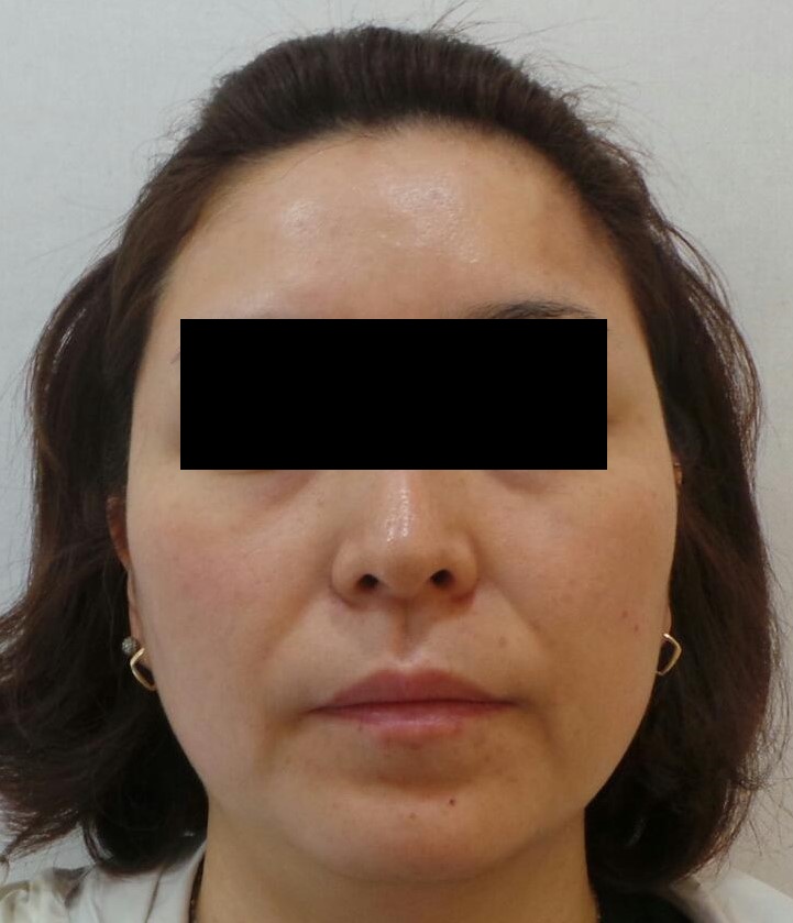 레이저 치료 완료 후 흑자증 병변이 제거된 모습