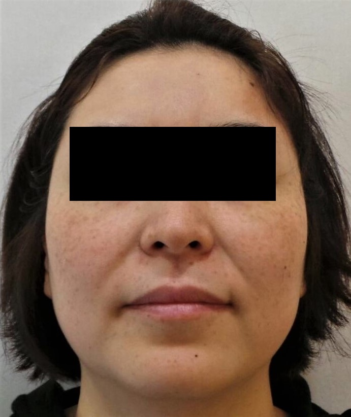 양 광대 및 볼에 분포하는 흑자증 색소 병변