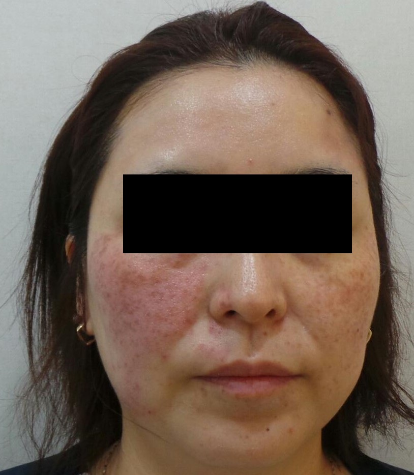 레이저 치료 후 붉어진 병변의 모습