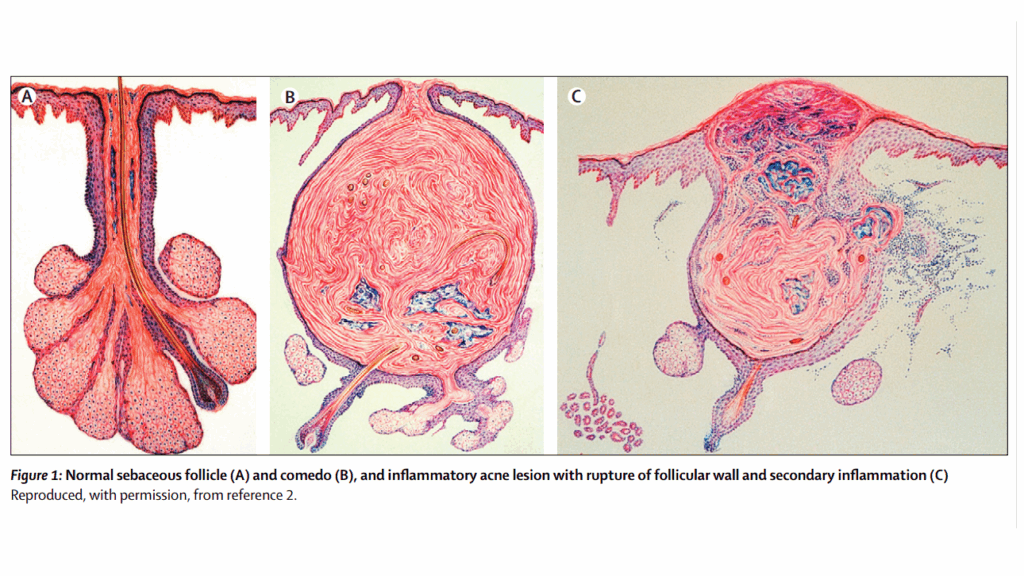 정상 모낭과 염증성 여드름의 비교