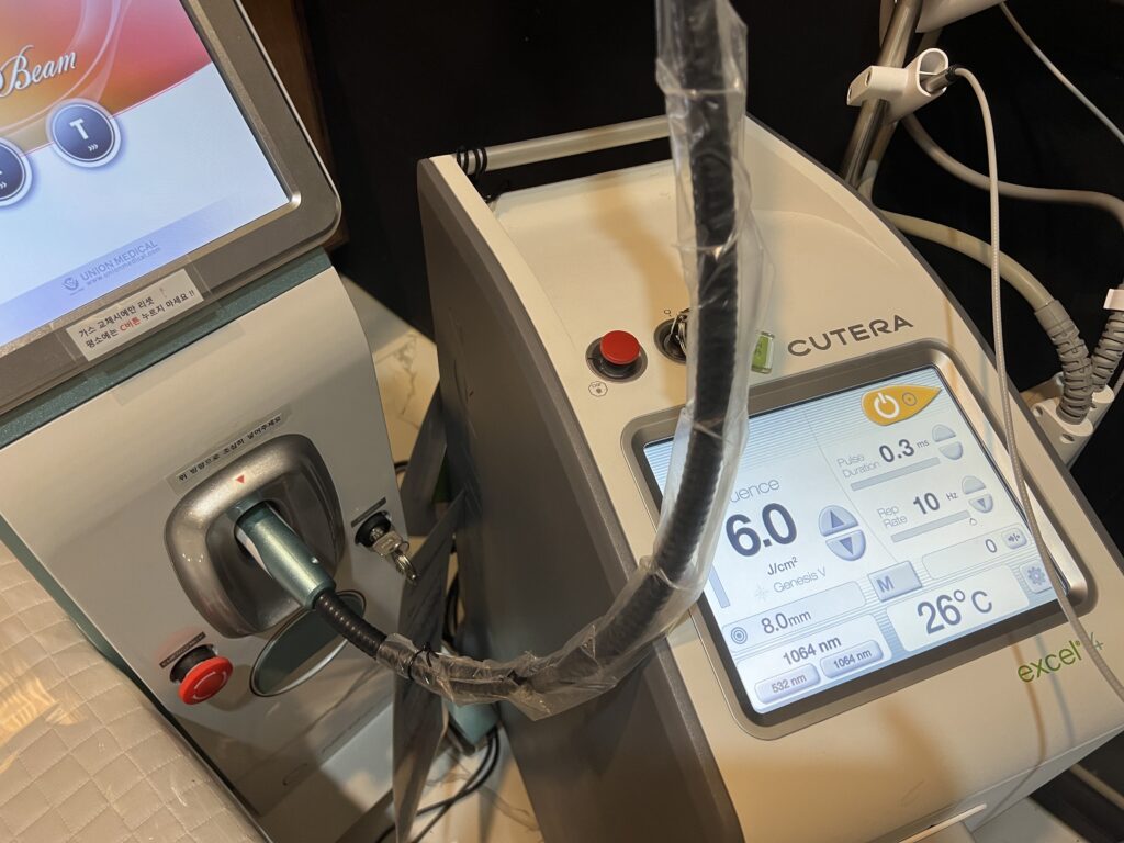 네오빔과 엑셀브이 플러스 레이저를 이용하여 활동성 여드름을 치료합니다.