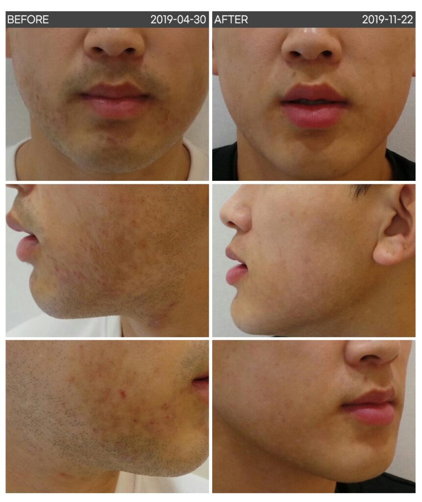 염증 후 색소침착 PIH 레이저 시행 전후