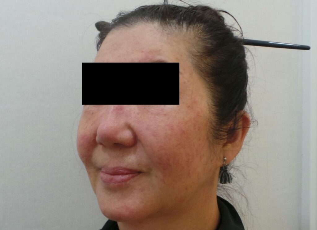 일산 리뉴앤영 홍조 및 주사 레이저 치료 1회 시행 후 붉은기가 개선된 모습.