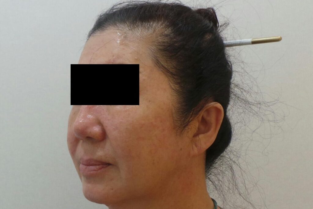 고양시 일산 리뉴앤영 의원에서 주사피부염 및 홍조 치료를 끝마치고 개선된 얼굴의 모습.