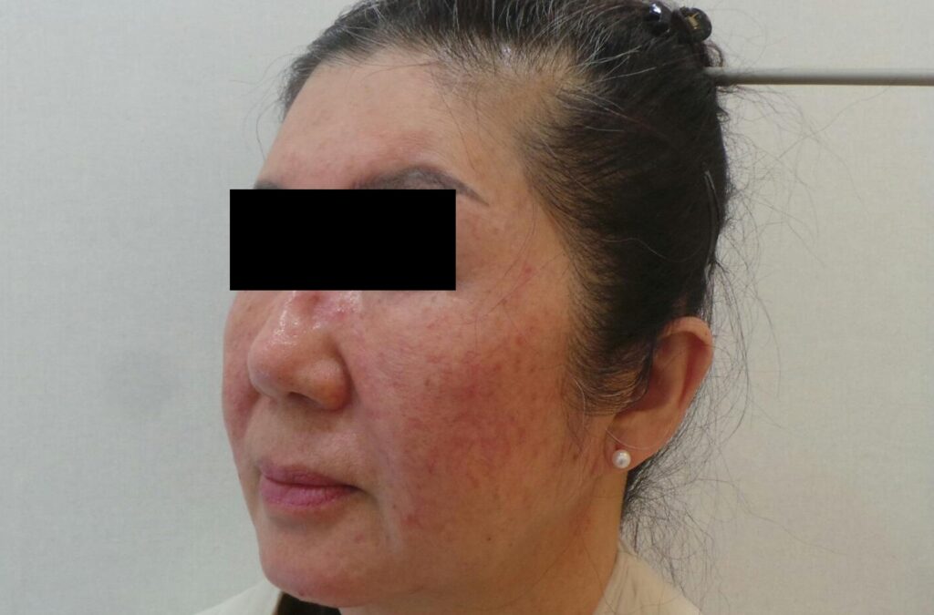 주사피부염 및 홍조 병변의 모습. 모세혈관이 늘어나고 붉은기가 심해지며, 코 및 볼의 염증성 구진이 관찰됨.