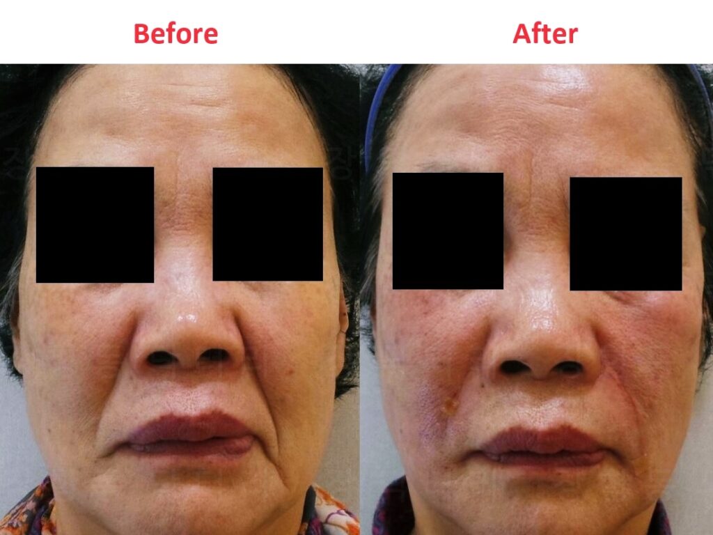 일산 리뉴앤영 의원에서 팔자 주름 필러 및 실리프팅 시술 전후 얼굴 변화. 오른쪽은 팔자 필러만 시행, 왼쪽은 팔자 실리프팅과 필러를 함께 시행.