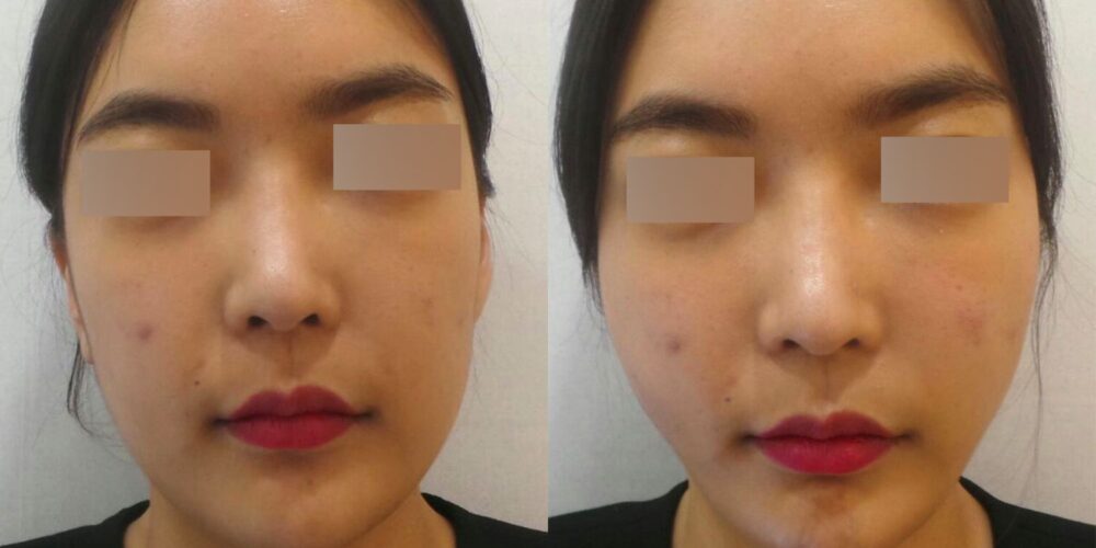 고양시 일산 리뉴앤영 실리프팅 전후사진, 젊은 연령대에서 하관에 몰린 볼살을 위로 이동시켜 둔해 보이던 턱선을 갸름한 브이라인으로 정리한 사례