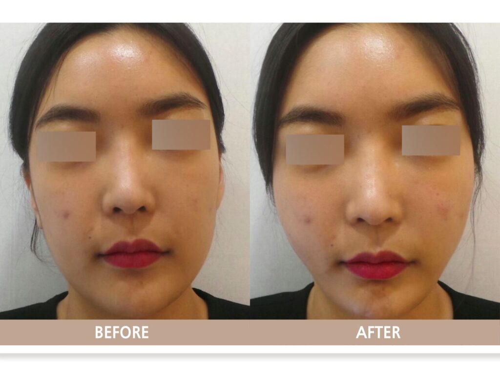 고양시 일산 리뉴앤영 실리프팅 전후사진, 젊은 연령대에서 하관에 몰린 볼살을 위로 이동시켜 둔해 보이던 턱선을 갸름한 브이라인으로 정리한 사례
