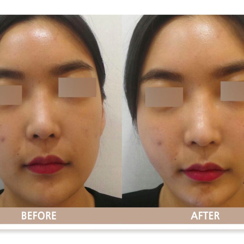 고양시 일산 리뉴앤영 실리프팅 전후사진, 젊은 연령대에서 하관에 몰린 볼살을 위로 이동시켜 둔해 보이던 턱선을 갸름한 브이라인으로 정리한 사례