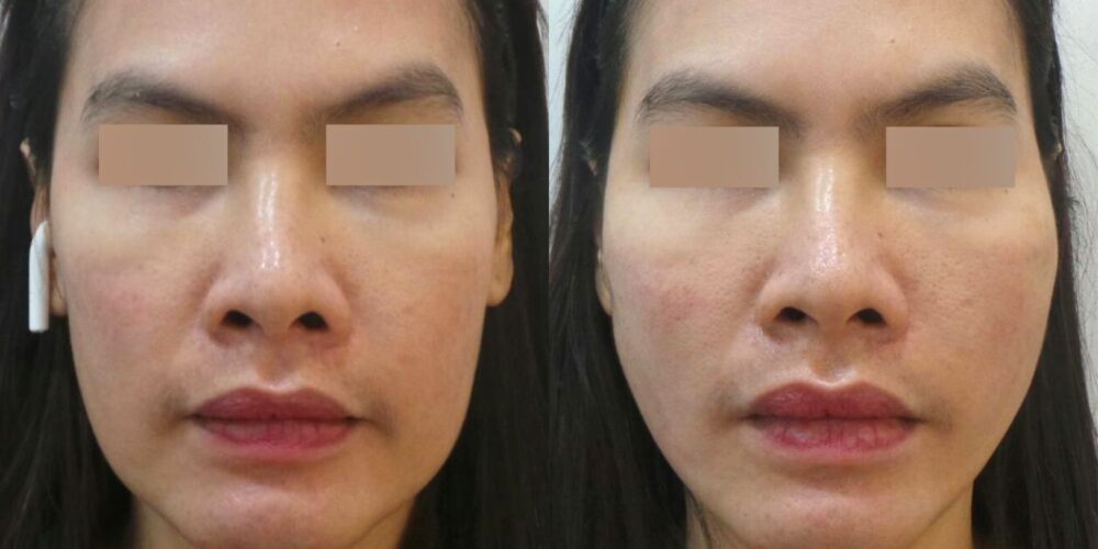 일산 실리프팅 전후사진, PDO 코그실을 이용해 처진 볼 아래 살을 끌어올려 옆볼 꺼짐이 개선된 사례.