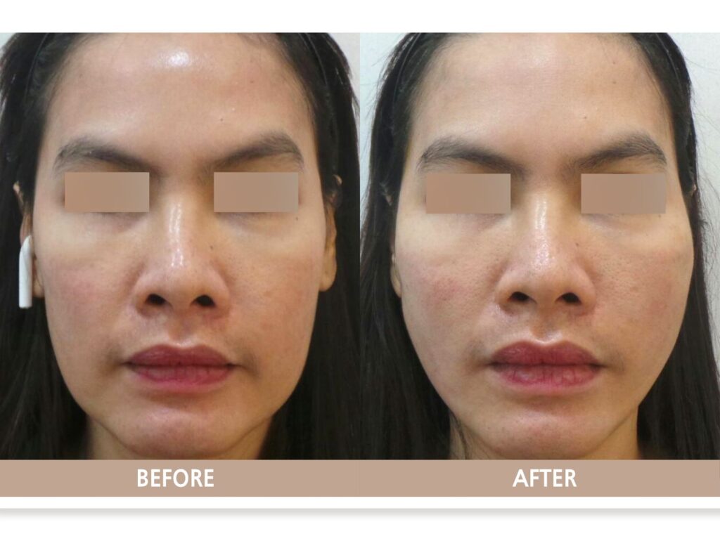 일산 실리프팅 전후사진, PDO 코그실을 이용해 처진 볼 아래 살을 끌어올려 옆볼 꺼짐이 개선된 사례.