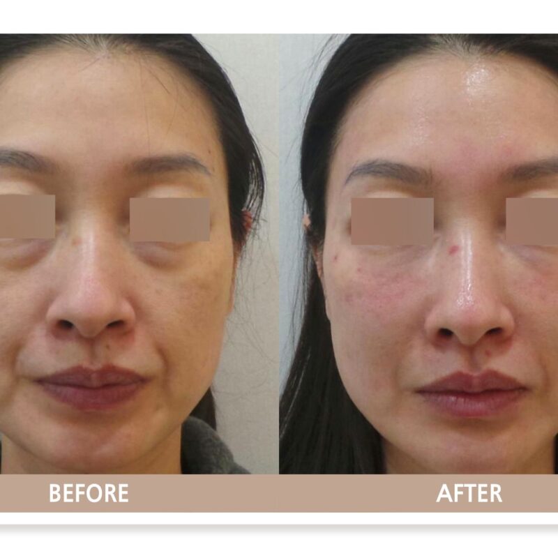 일산 눈밑필러 전후사진, 다크서클과 눈밑 꺼짐을 소량 필러로 자연스럽게 개선한 사례