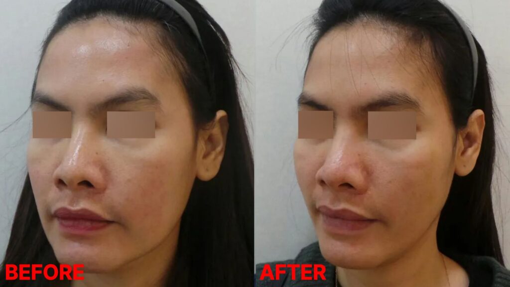 실리프팅 전후사진 45도 사선 비교, 시술 2주 후 붓기가 가라앉은 상태에서 PDO 코그실로 턱라인과 하부 볼 처짐이 정돈된 변화를 확인할 수 있는 모습